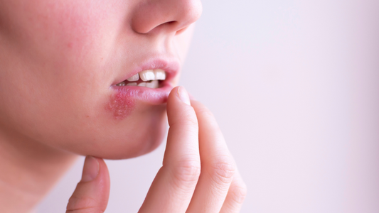 How to avoid getting cold sores